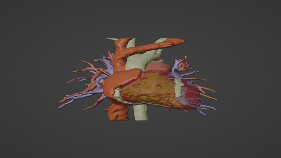 3d model human heart double aortic arch daa - generated real patient cardiovascular cardiac system chambers apical view cardiology 3d print model - Mito3D