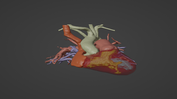 3d model human heart double outlet right ventricle dorv - generated real patient cardiovascular cardiac system chambers apical view cardiology 3d print model - Mito3D