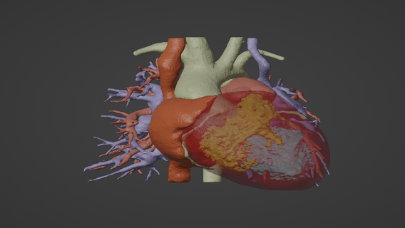 3d model human heart double superior vena cava dsvc - generated real patient cardiovascular cardiac system chambers apical view cardiology 3d print model - Mito3D