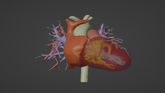3d model human heart hypertrophic cardiomyopathy - generated real patient heart cardiovascular cardiac cardiovascular system heart chambers 3d model heart cardiology 3d model heart chambers  3d print model - Mito3D