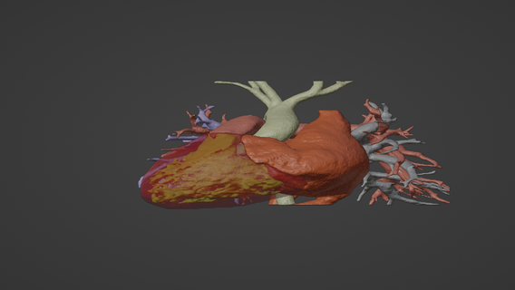 3d model human heart mirror dextrocentric - generated real patient cardiovascular cardiac system chambers apical view cardiology 3d print model - Mito3D