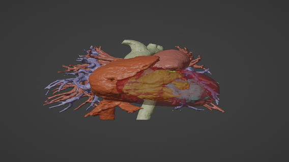3d model human heart patent ductus arteriosus pda - generated real patient cardiovascular cardiac system chambers cardiology congential disease 3d print model - Mito3D