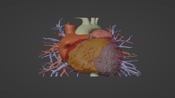 3d modelo humano coração pulmonar artéria Funda gerado real paciente cardiovascular cardíaco câmaras cardiologia 3d print model - Mito3D