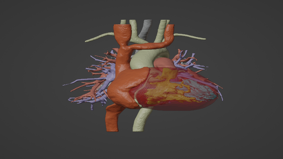 3d model human heart tetrology fallot tof - generated real patient cardiovascular cardiac system chambers apical view cardiology aorta aortic congenital disease 3d print model - Mito3D
