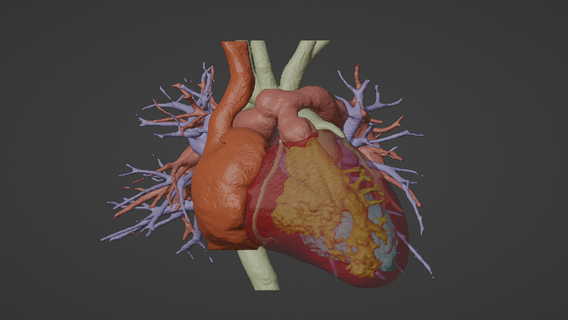 3d model human heart transposition great arteries tga - generated real patient cardiovascular cardiac system chambers apical view cardiology 3d print model - Mito3D