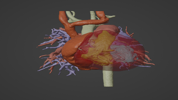 3d model insan kalp ventriküler bölme kusur vsd kardiyovasküler sistemi Odalar apikal görünüm kardiyoloji aort doğuştan hastalık 3d print model - Mito3D