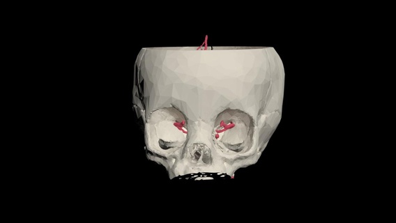 3d modello mezzo cerebrale arteria mca aneurisma cervello cranio lasciare chirurgia neurochirurgia 3d print model - Mito3D