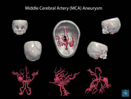3d model middle cerebral artery mca aneurysm Various brain skull rupture surgery neurosurgery 3d print model - Mito3D