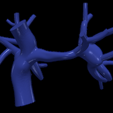 3d model pulmonary arteries fontan procedure 3d print model - Mito3D