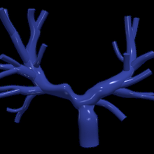 3d modèle pulmonaire artères Fontaine procédure 3d print model - Mito3D