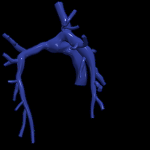3d model pulmonary arteries fontan procedure 3d print model - Mito3D