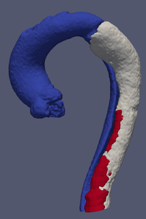 3d model type-b aortic dissection tbad - generated real patient heart cardiovascular cardiac system chambers apical view cardiology aorta type b disease 3d print model - Mito3D