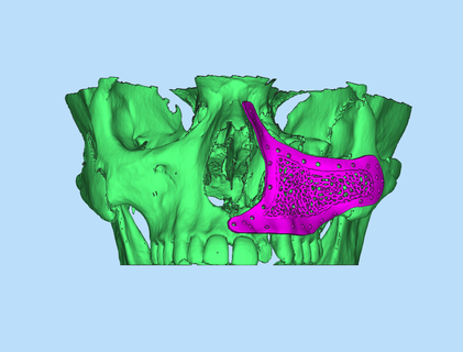 3d printed maxilla implants facial rehabilitation 3d print model - Mito3D