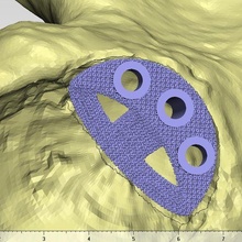 acetabolo aumentare individuale protesica attrezzo medicinale operazione chirurgia medico 3d stampato sla Ciao titanio bioingegnere pn 3d print model - Mito3D