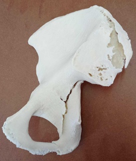 acetabulum fracture orthopedics traumatology pelvis trauma osteosynthesis 3d print model - Mito3D