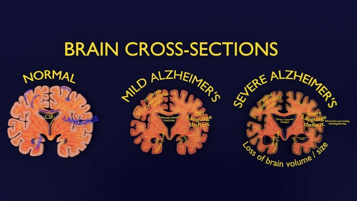 alzheimer hastalık beyin koronal dilim s sinirli sistemi insan tıbbi bilim hafıza anatomi merkezi yaşlı harman demans kayıp 3d print model - Mito3D