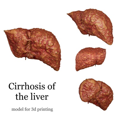 anatomical model of liver cirrhosis anatomy ready to print 3d print model - Mito3D