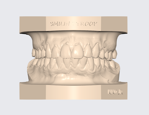 artikuliert oberer höher dental modell 3 orthopädietechniker techniker zahn 3d stl zahnarzt frei kieferorthopädie drucken 3d print model - Mito3D