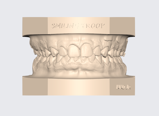 articulado superior dental modelo 5 protésico técnico diente 3d stl dentista gratis ortodoncia impresión 3d print model - Mito3D