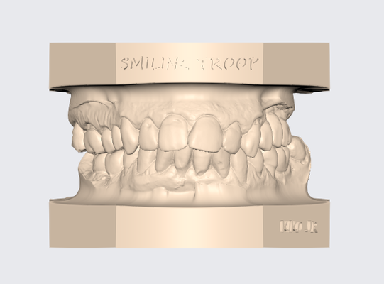 articulado superior dental modelo 7 protésico técnico diente 3d stl dentista gratis ortodoncia impresión 3d print model - Mito3D