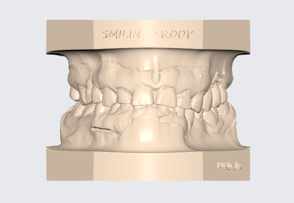 articulado superior dental modelo 8 protesista técnico impressão dente 3d stl dentista livre ortodontia 3d print model - Mito3D