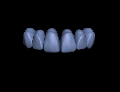 biblioteca dientes 13 23 stl impresión 3d ortodoncia depilación modelo impreso base superiores resina 3d print model - Mito3D