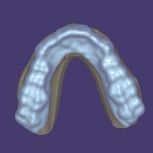 bite splint + upper model rest plate dental 3d print model - Mito3D