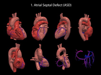 angeboren Herz Krankheit 7pack verschiedene kardiovaskulär System Kammern 3d Modell apikal Aussicht Kardiologie 3d print model - Mito3D