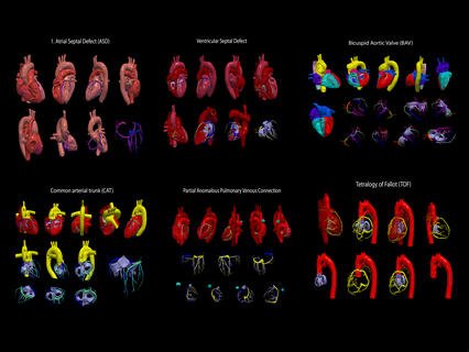 congenital heart disease - 7pack cardiovascular cardiac transposition great arteries defects atrial septal defect ventricular bicuspid aortic valve common arterial trunk partial anomalous pulmonary venous 3d print model - Mito3D