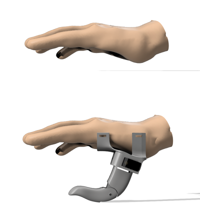 cost professional prosthesis robotic thumb amputed hand - amputated medical device prototype adaptive arduino robot multicolor electronics robotics protesis ender articulated 3d print model - Mito3D