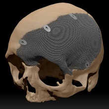 craneal plato antropométrico datos interesante caso funda herramienta medicamento cirugía cráneo bala herida reconstrucción implante Sla titanio médico bioingeniero pn 3d print model - Mito3D
