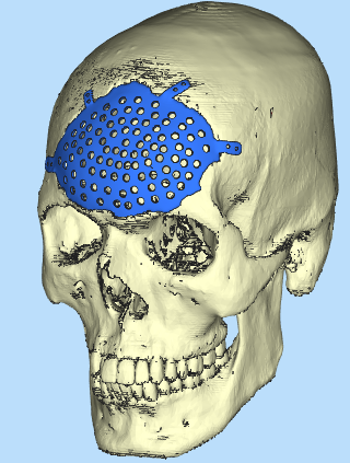 cranial prato acordo defeito medicamento cirurgia crânio interessante caso bainha bala ferida reconstrução implantar sla titânio médico bioengenheiro pn 3D print model - Mito3D