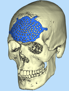 craneal plato acuerdo defecto medicamento cirugía cráneo interesante caso funda bala herida reconstrucción implante Sla titanio médico bioingeniero pn 3d print model - Mito3D