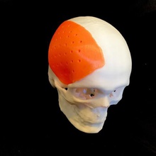 craniofacial implant 3dprint model various skull medicine face head surgery anatomy 3d print model - Mito3D