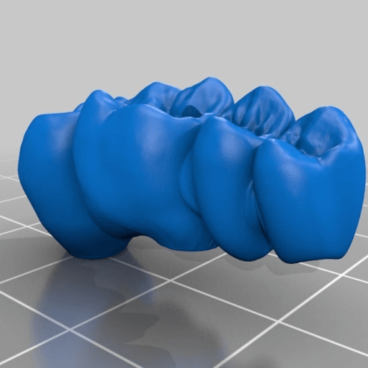 ponts dentaires implants divers de la biologie dent dents implant dentalmodel dentalimplant dentaire pont 3D print model - Mito3D
