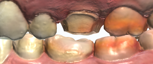 dental diseño práctica intraoral escaneos dientes anatomía odontología diente maxilar médico cadcam canalla exocad 3shape 3d print model - Mito3D