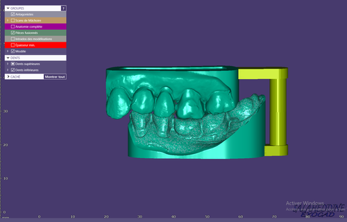 dentaire incruster modèle prothèse dentaire 3d print model - Mito3D