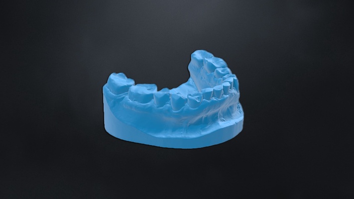 dental model 3dprint severe abrasion 3dmodel dentist dentistry denture human teeth tooth jaw 3d print model - Mito3D