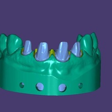 dentaire modèle précédent amovible meurt pont faire face denta 3dprint empreinte résine 3dprinter professionnel exocad 3d print model - Mito3D
