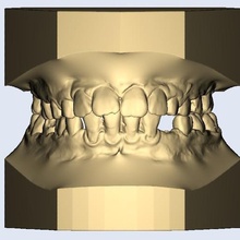 dental model child narrow teeth various teetheeth dentist models 3d print model - Mito3D