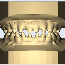dental modello bambino di denti affilati vari i aguzzi il dentista modelli 3d print model - Mito3D