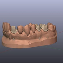 dental modelo mestre morre 11 15 16 dente dentes dental3d cafajeste 3dprint 3d dentista técnico 3d print model - Mito3D