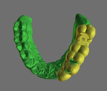 dental quirúrgico guía rail Superior maxilar modelo cirugía guiado modelos práctica odontología implantologia maxilofacial simulación educación implantes procedimientos anatomía formación habilidades 3d print model - Mito3D