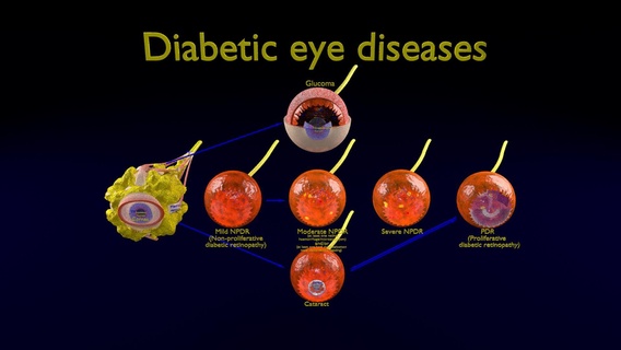 diabetic eye diseases model diabetes disease retinopathy glucoma cataract human medical pathology science 3d print model - Mito3D