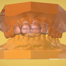 digital anti-enxaqueca aparelho vários Impressoras 3d Scanner médica dental 3shape designer de 2015 rhino 5 keyshot pro 52 3d print model - Mito3D