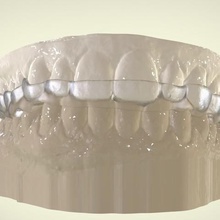 digital mordida de sensibilização tala vários dental ortodontia o cad 3d Impressão 3d print model - Mito3D