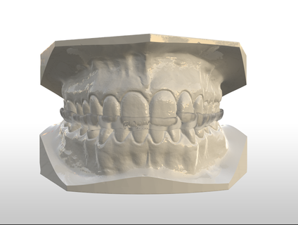 digital coverage occlusal splint canine guidance 3d cad splints dental medical devices teeth 3d print model - Mito3D