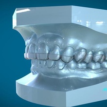 dentaire numérique dayguard attelle divers Cao 3d dent la prothèse 3shape 3d print model - Mito3D