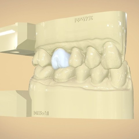dijital diş tam kontur taç quadrantmodel çeşitli 3d baskı cad model hekimliği hendeğe ölmek 3D print model - Mito3D