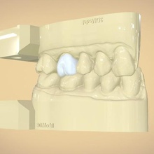 digital dental quadrantmodel full contour crown verschiedene 3d-drucken cad digitales Modell Zahnmedizin Zähne ditched sterben 3d print model - Mito3D